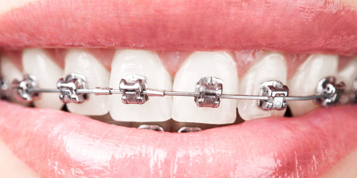 Stainless steel wire for braces