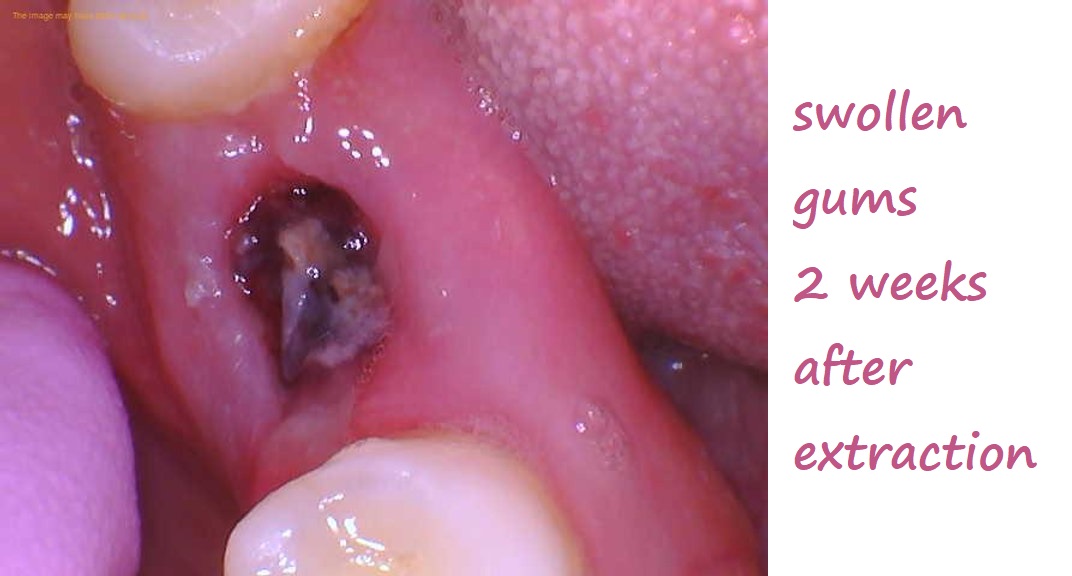 swollen gums 2 weeks after extraction