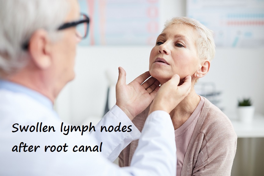 swollen lymph nodes after root canal