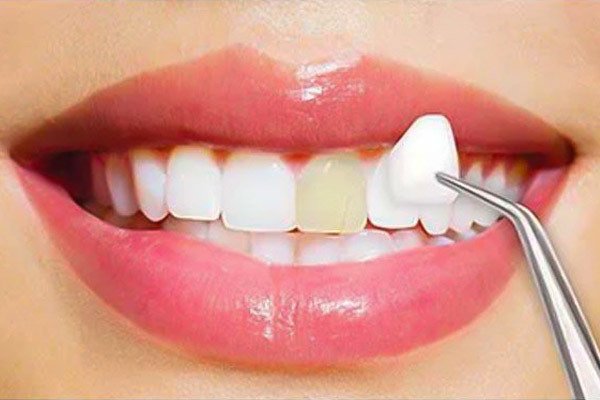 teeth bonding vs veneers