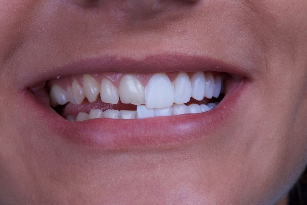 teeth bonding vs veneers