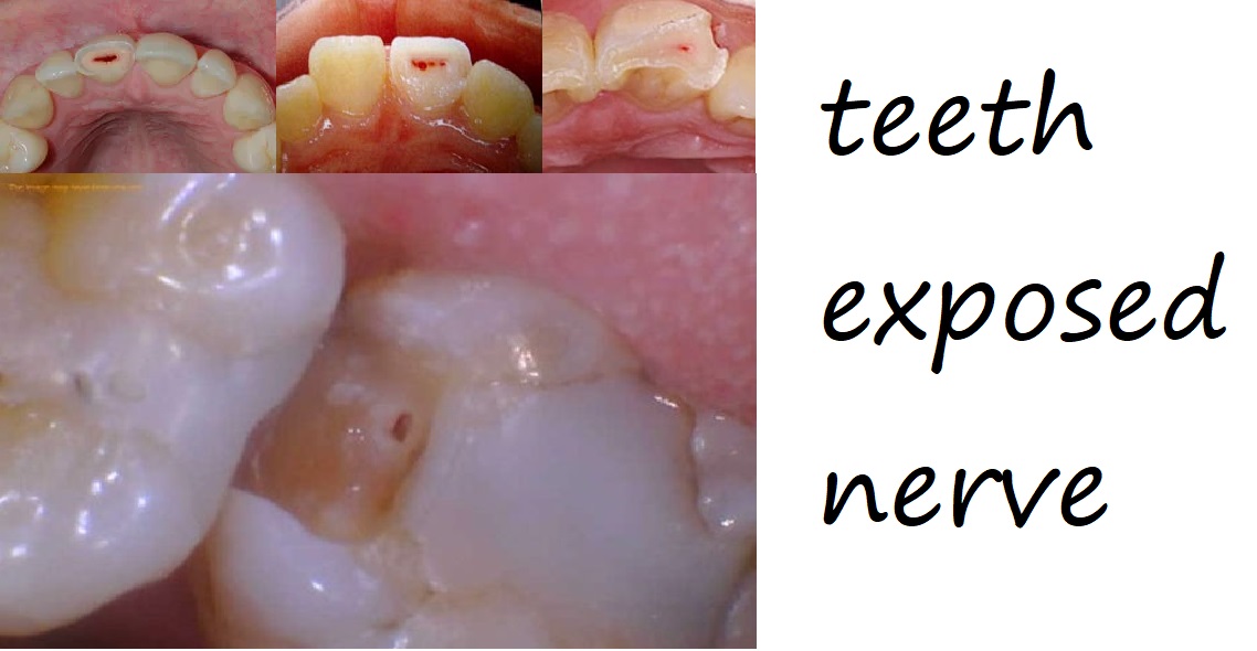 teeth exposed nerve