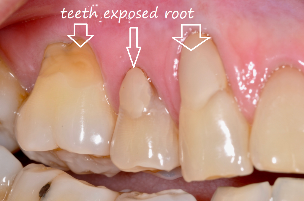 teeth exposed root