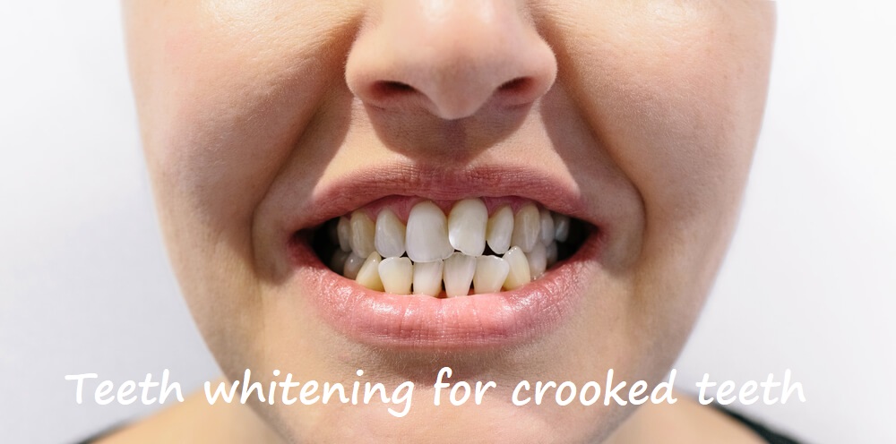 teeth whitening for crooked teeth