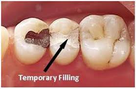 temporary tooth filling