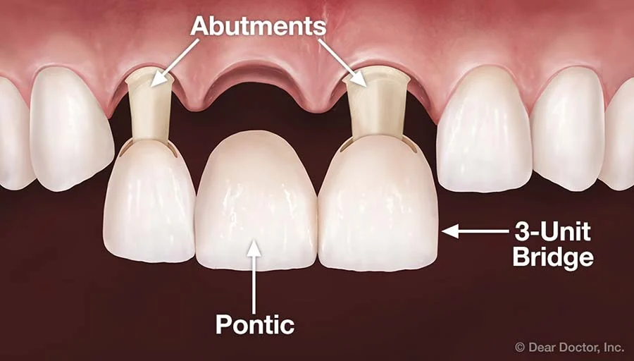 three unit bridge dental