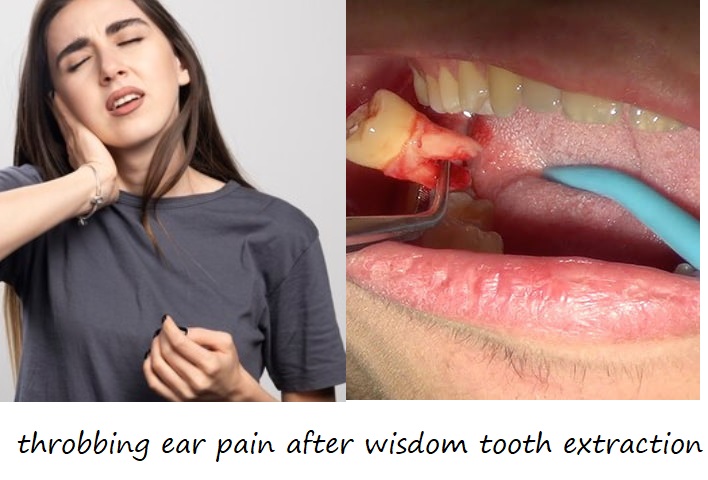 throbbing ear pain after wisdom tooth extraction