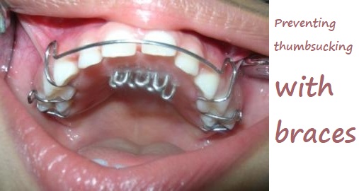 thumbsucking with braces