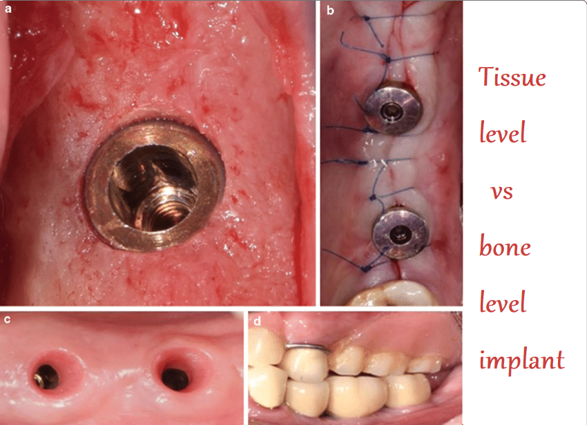 Tissue level vs bone level implant