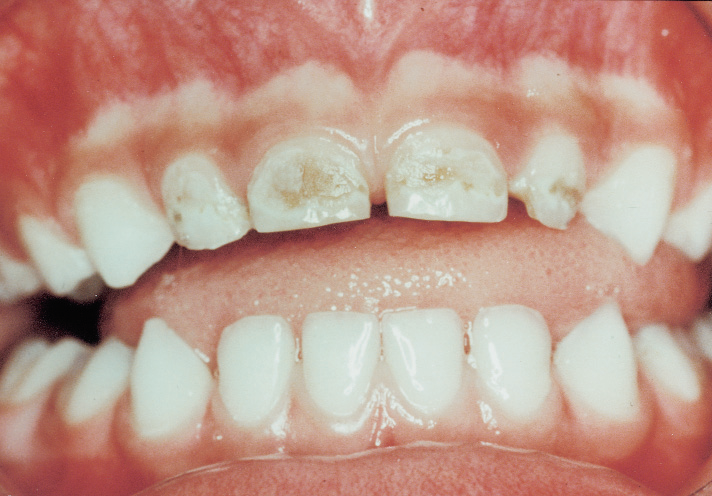 toddler teeth brown near gums