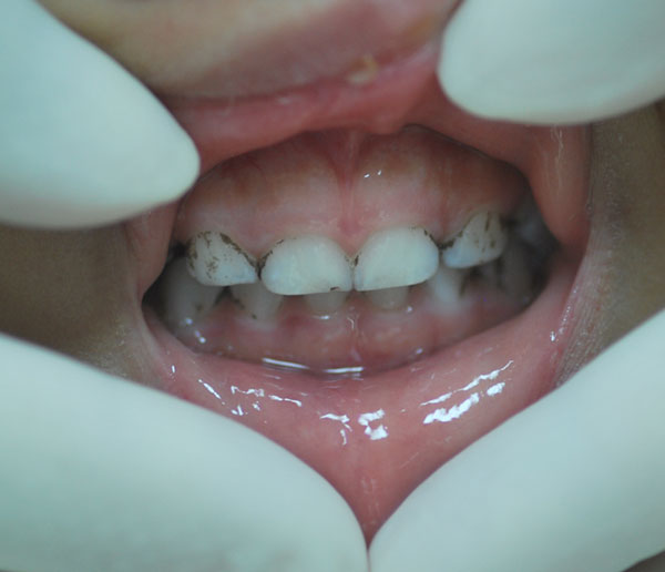 toddler teeth gray near gum line