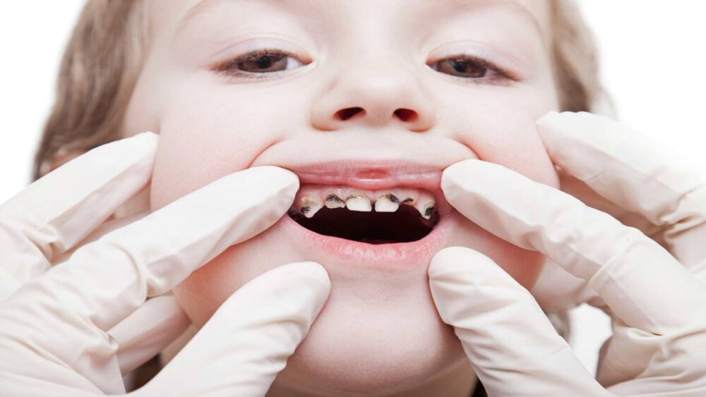 toddler tooth decay reversal