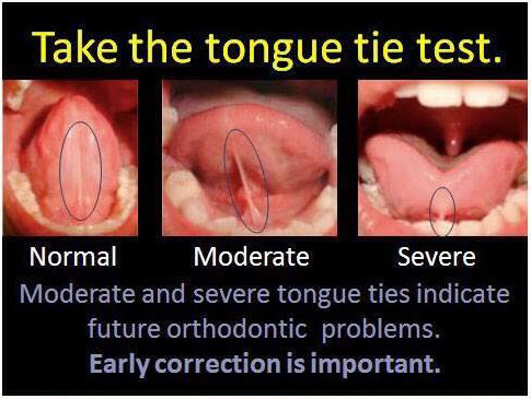 tongue tie adults test