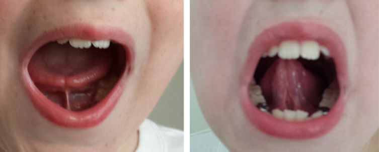 tongue tie vs normal adults