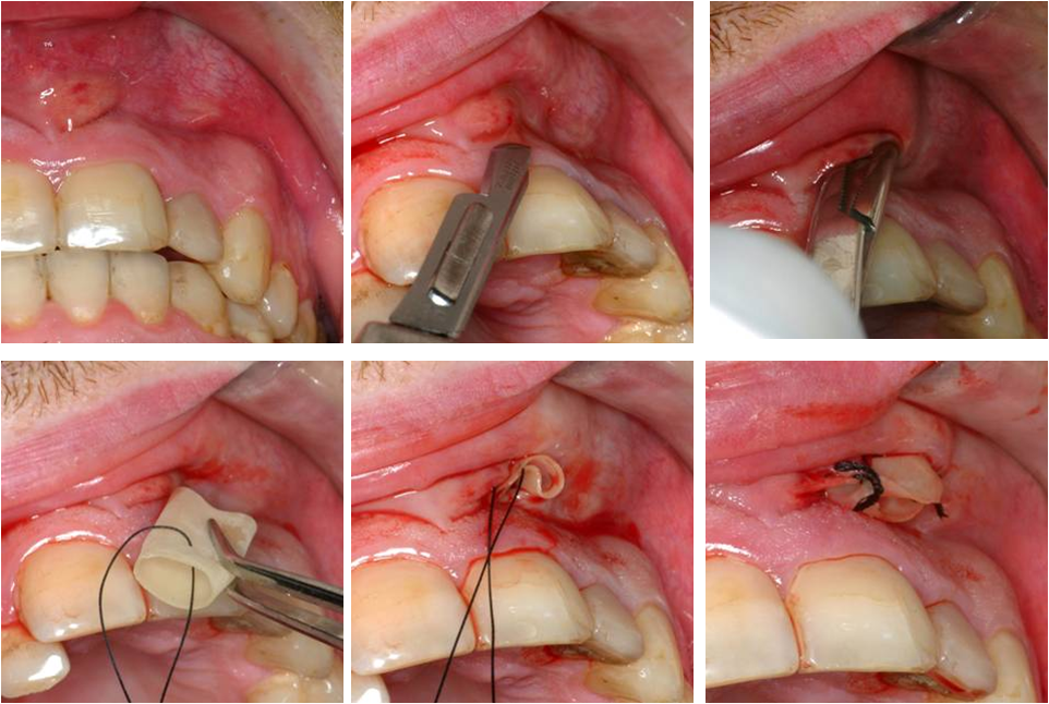 how to drain a tooth abscess at home