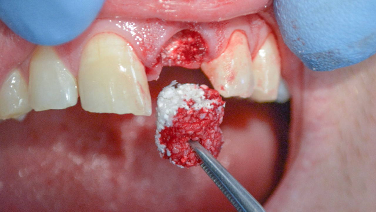 Tooth Bone Graft