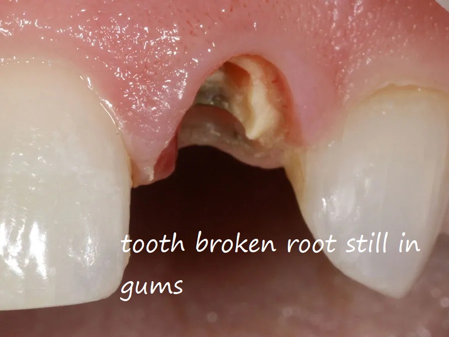 tooth broken root still in gums