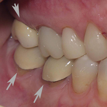 tooth cap vs crown