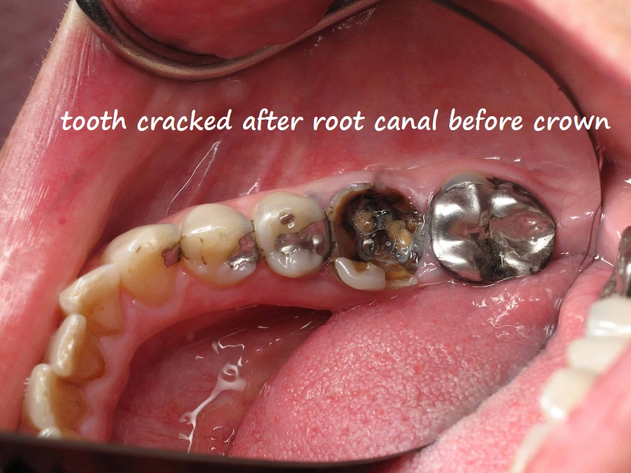 tooth cracked after root canal before crown