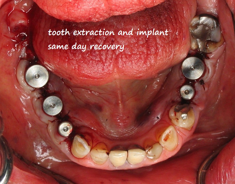 tooth extraction and implant same day recovery