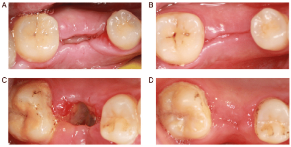 Tooth extraction healing stages
