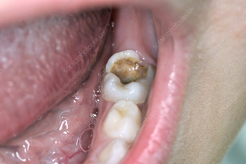 tooth filling fell out