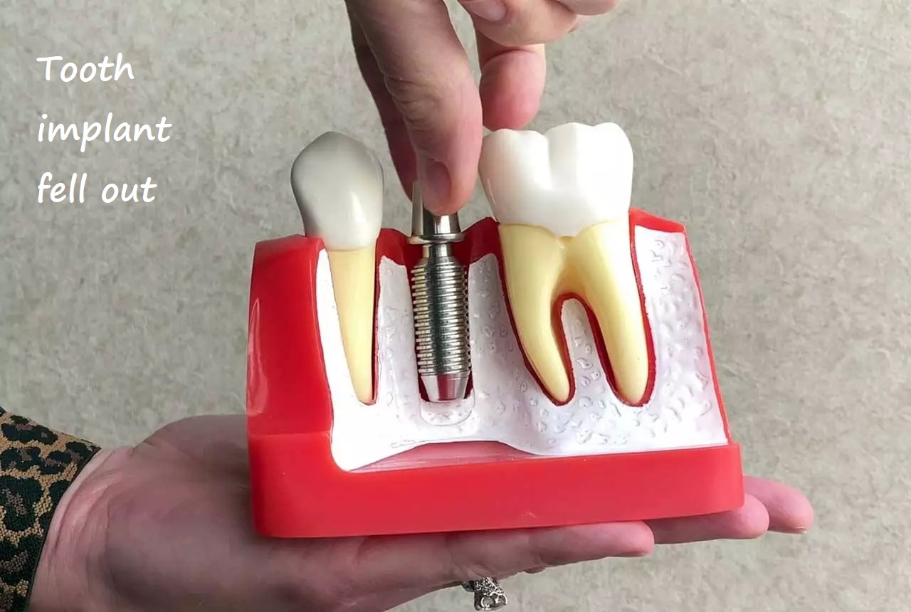 tooth implant fell out