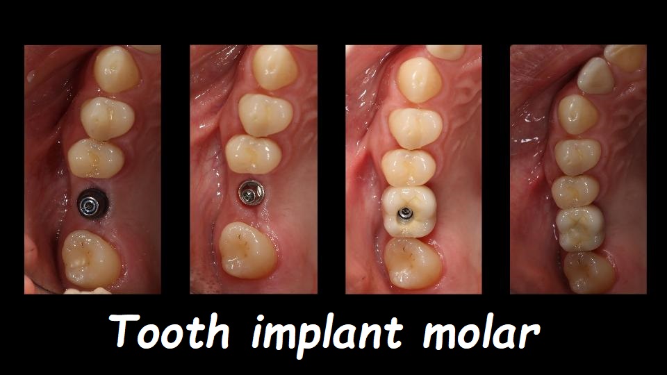 Tooth implant molar