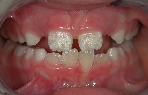 tooth sealant front teeth