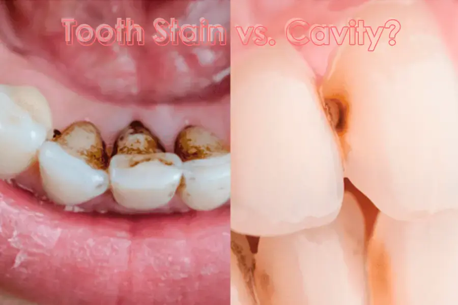 Tooth Stain vs. Cavity