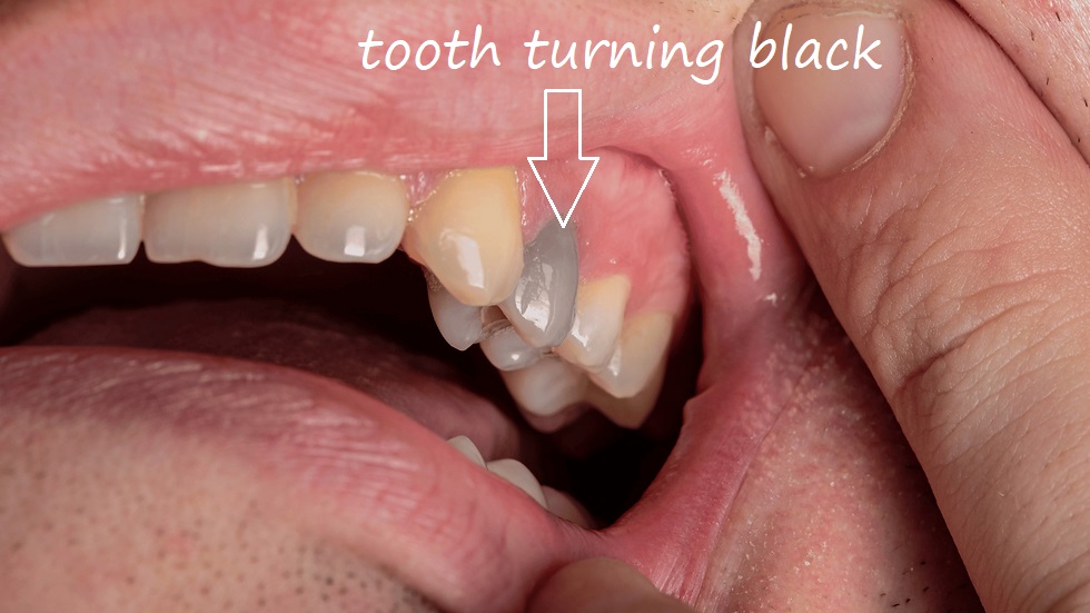 tooth turning black