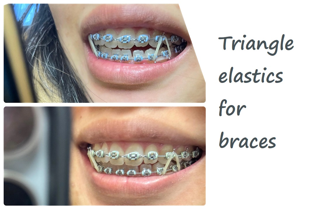 triangle elastics for braces