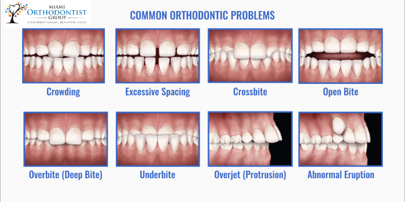 types of bites teeth