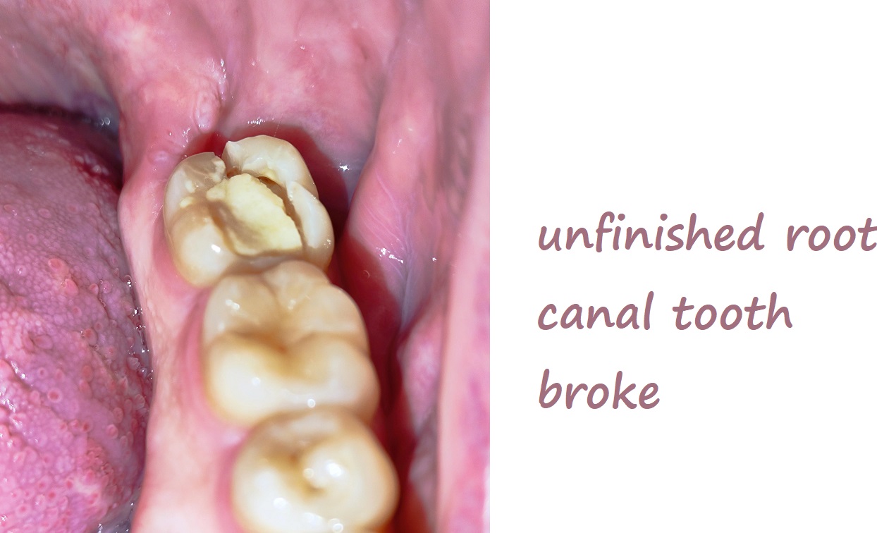 unfinished root canal tooth broke