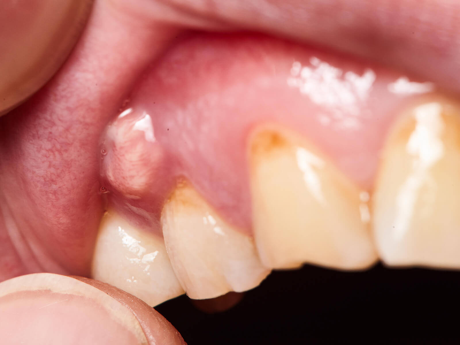 urgent care for tooth abscess