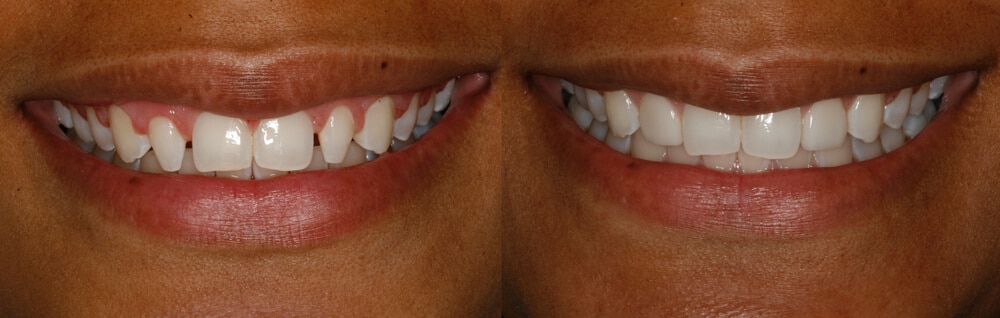 veneers for small teeth