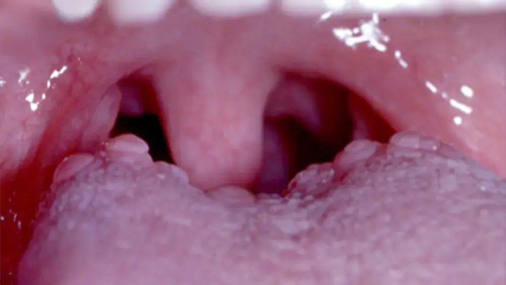 wart like bumps on back of tongue