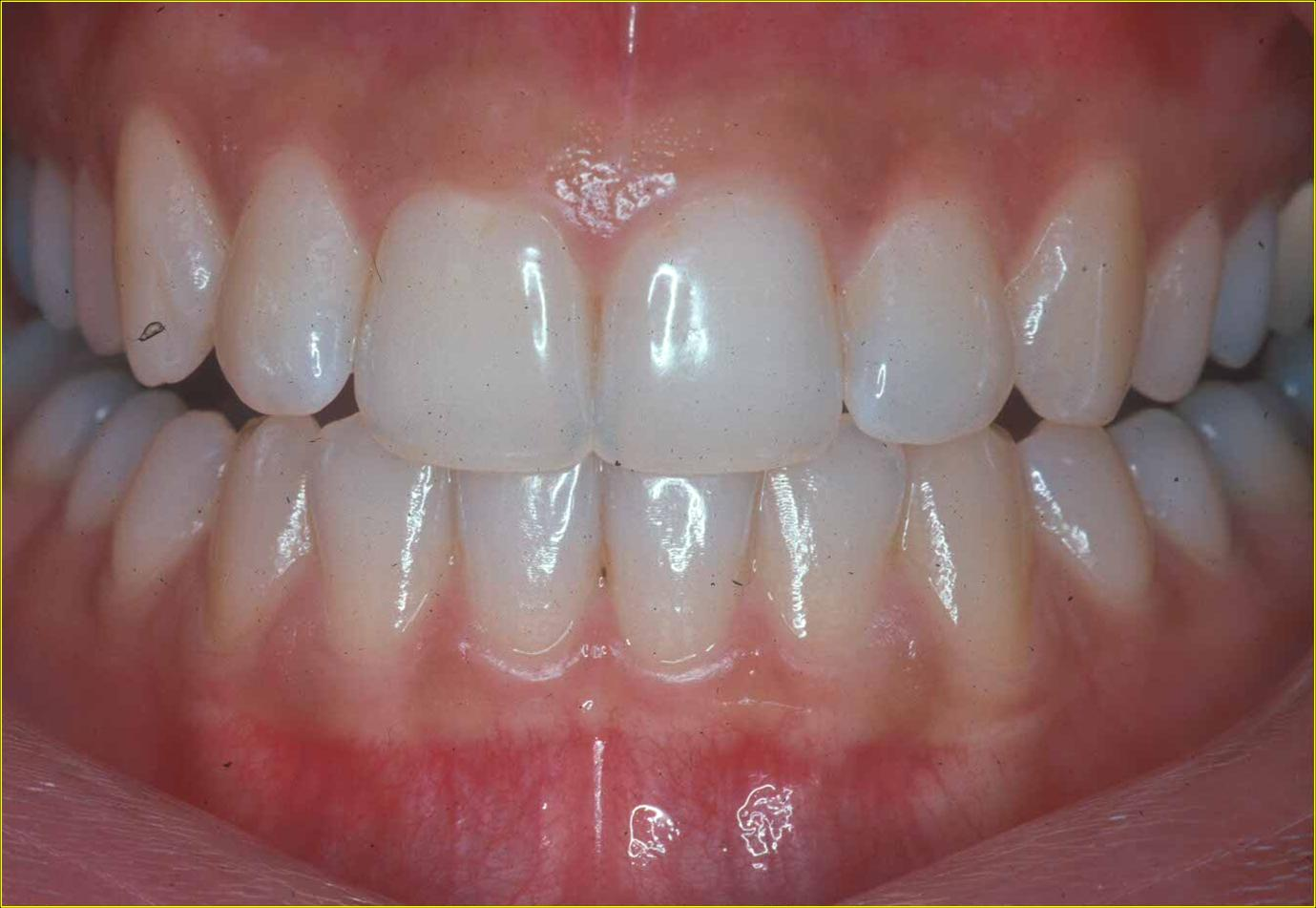 what do healthy gums look like