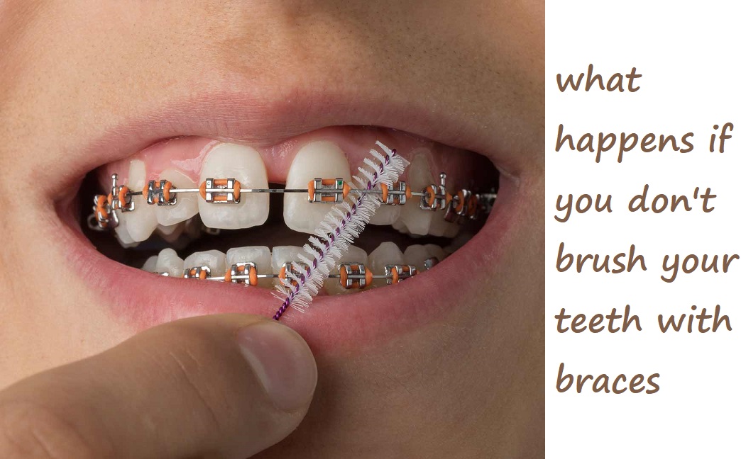 what happens if you don’t brush your teeth with braces