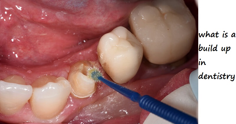 what is a build up in dentistry