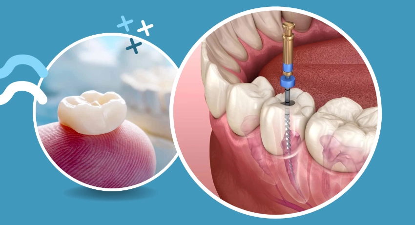 what is worse a crown or root canal