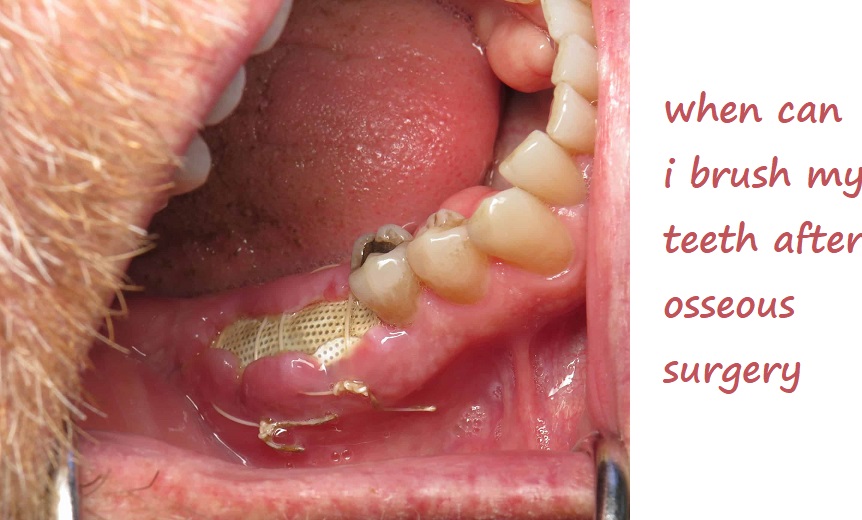 when can i brush my teeth after osseous surgery