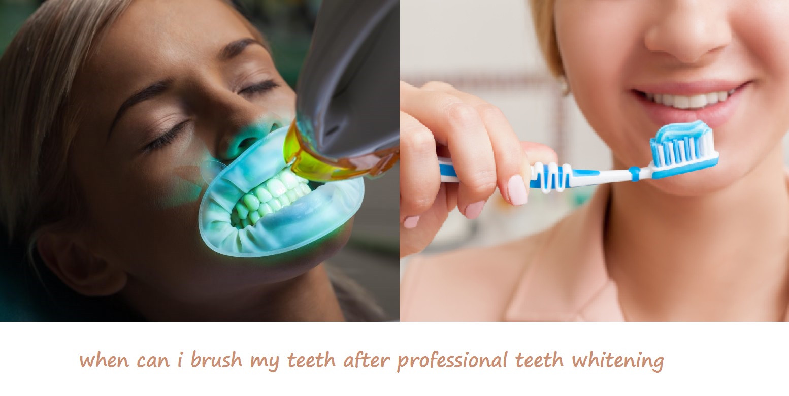 when can i brush my teeth after professional teeth whitening