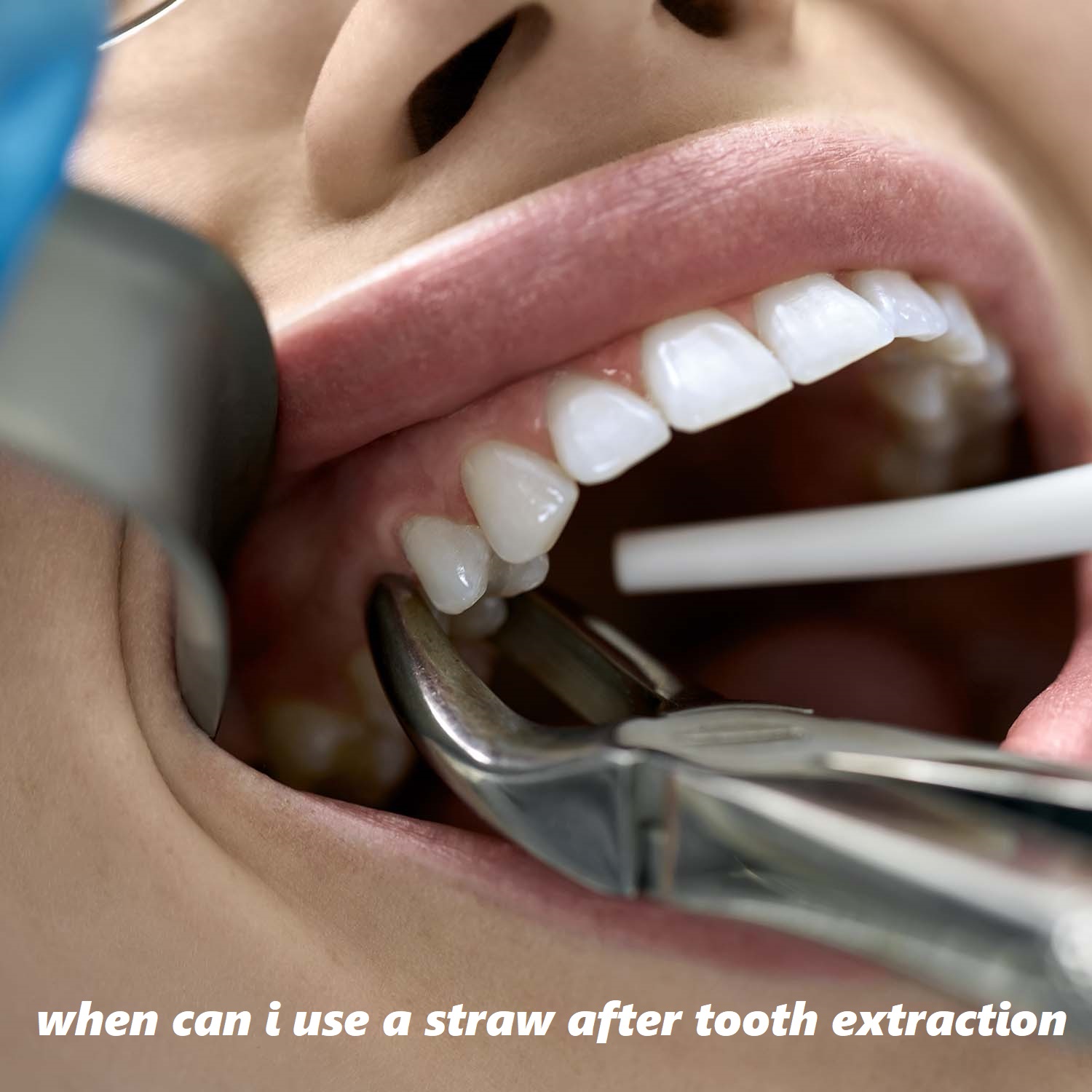 when can i use a straw after tooth extraction