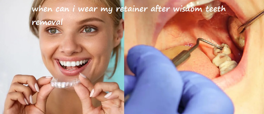 when can i wear my retainer after wisdom teeth removal