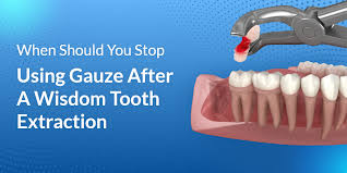 when should i stop using gauze after wisdom teeth