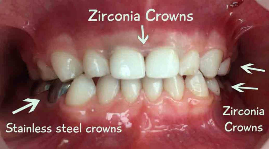 white crown tooth