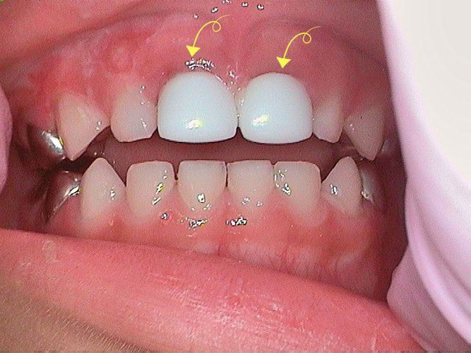 white crowns on toddler teeth