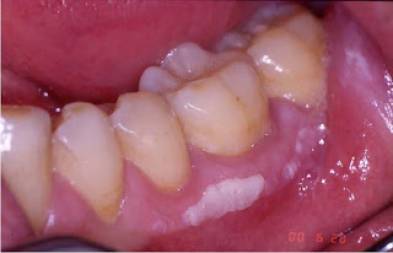 white gums