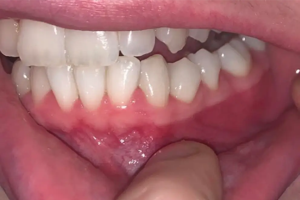 white gums